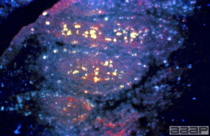 Immunofluorescent staining of a section of the bursa infected with a virulent strain of IBDV 2 days postinfection. The virus is replicating in cells throughout the follicles. Slide 11