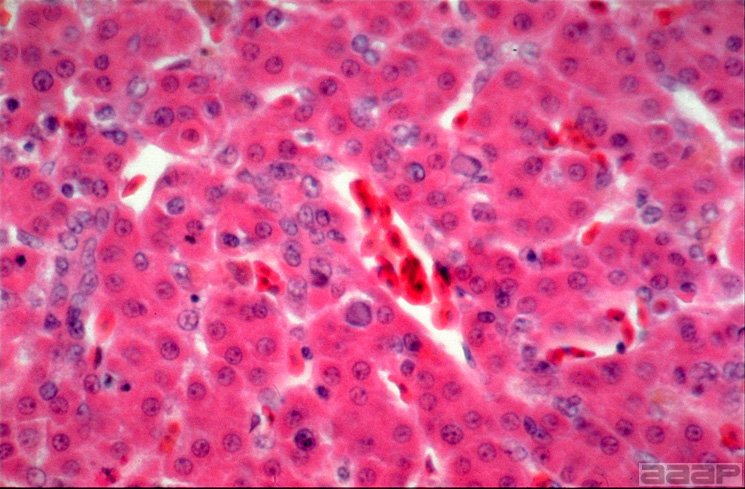 Section of liver from a MSD virus-infected pheasant contains a typical intranuclear inclusion in the center of the field. Slide 13