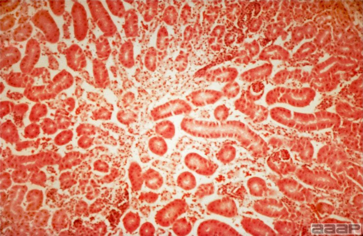 Microscopic lesions in the liver Slide 13