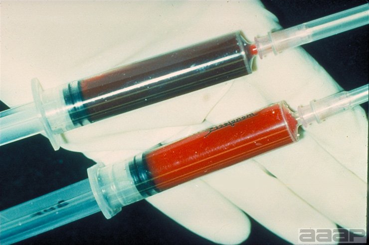 Blood in the syringes showing pale blood due to anemia in a CIAV infected bird compared to blood from an uninfected bird. Slide 3