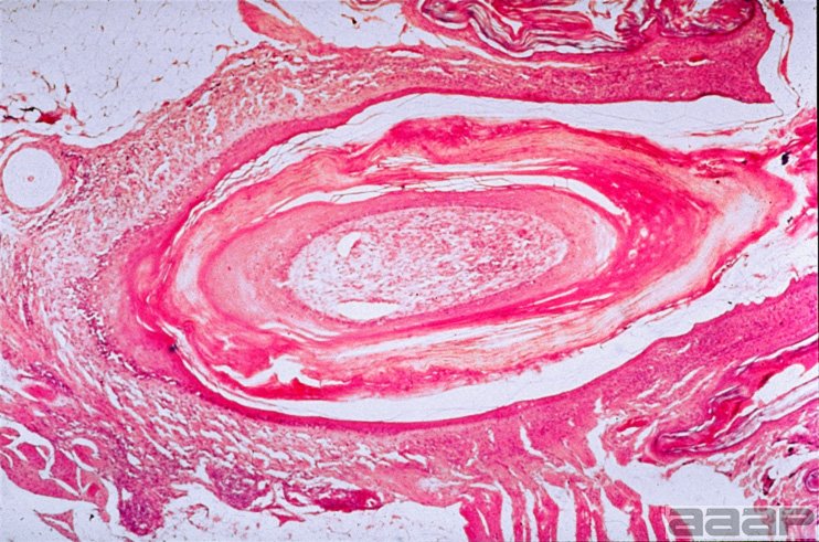 Microscopic lesions include hyperkeratosis of the feather shaft, which inhibits the normal ex sheathing process of the feather leading to the gross feather abnormalities. Slide 9