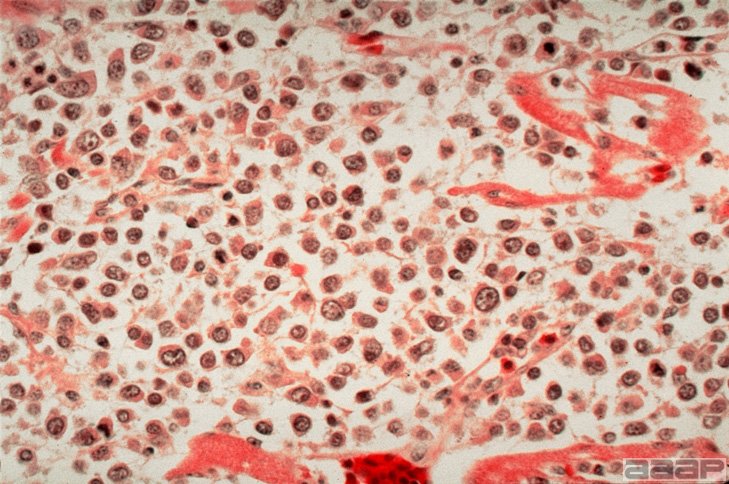Histopathology of heart: Diffuse infiltration of lymphocytes (see slide 10) and histiocytes (as shown). Slide 11