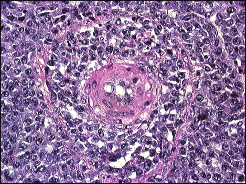 Lymphoid leukosis alt