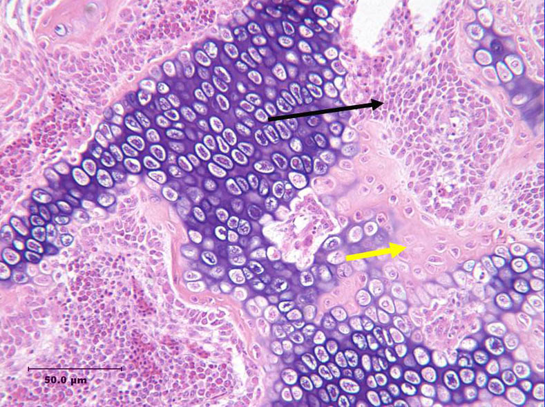 Phosphorus deficient rickets. Bone histo X20. Large numbers of osteblasts (black arrow) are present and osteclasts are few in number. Osteoid (yellow arrow). Slide 80