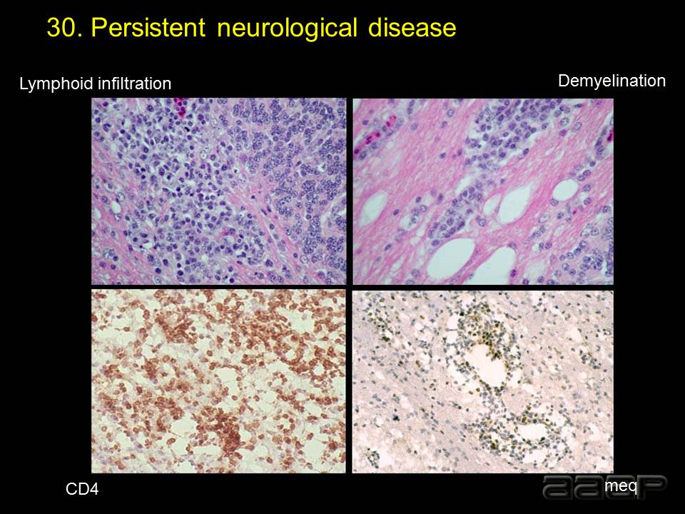 Persistent neurological disease lesions Slide 30